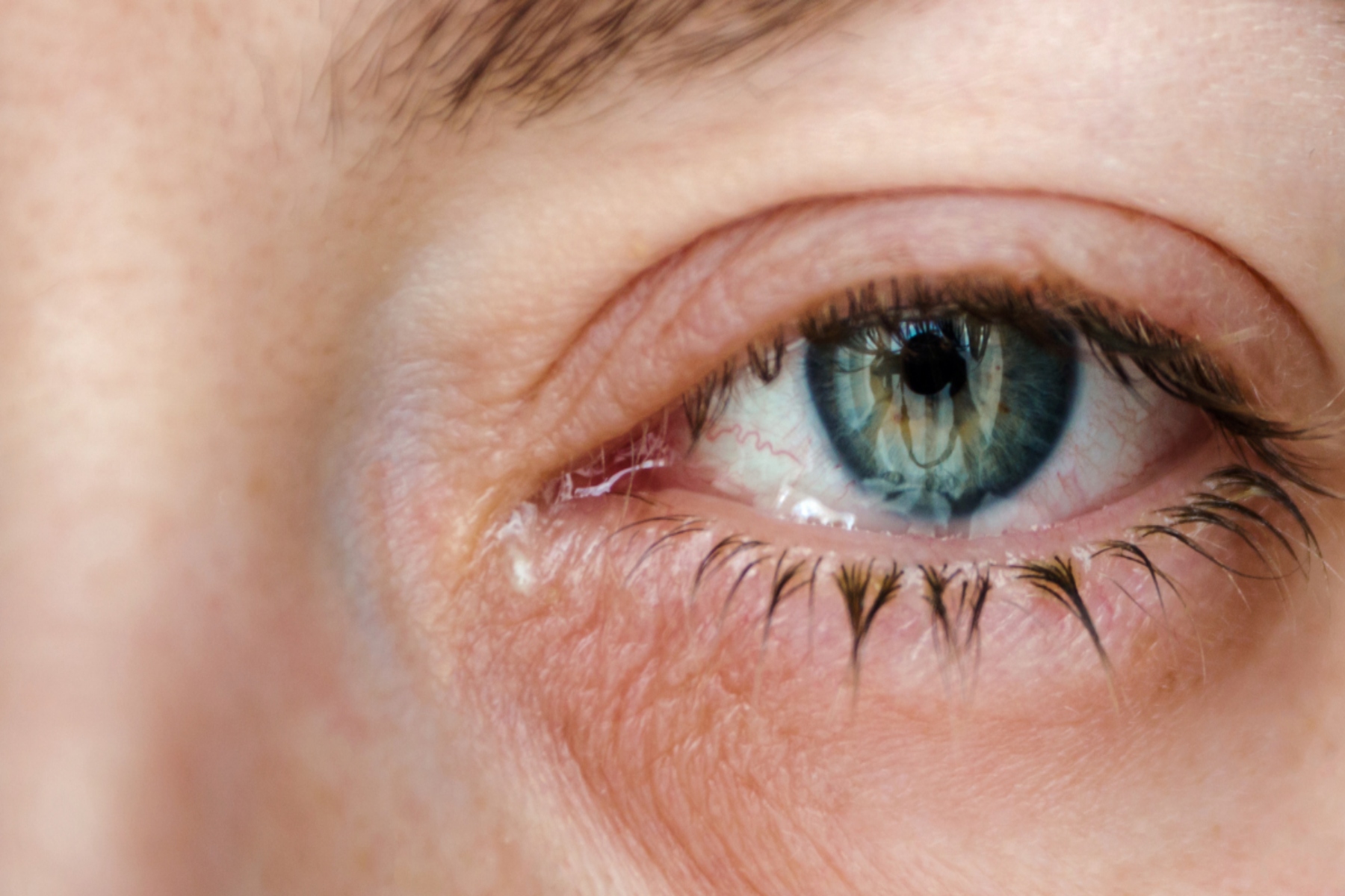 Ηλικιακή Εκφύλιση της Ωχράς Κηλίδας: Δύο ξεχωριστές οφθαλμικές παθήσεις μπορεί να συμβάλλουν στην κοινή τυφλωτική πάθηση των ματιών
