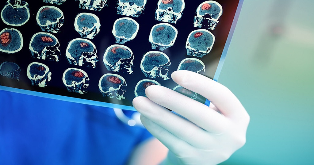 Εγκεφαλικό: Αποκατάσταση με ρινικό σπρέι – Πειραματικό στάδιο