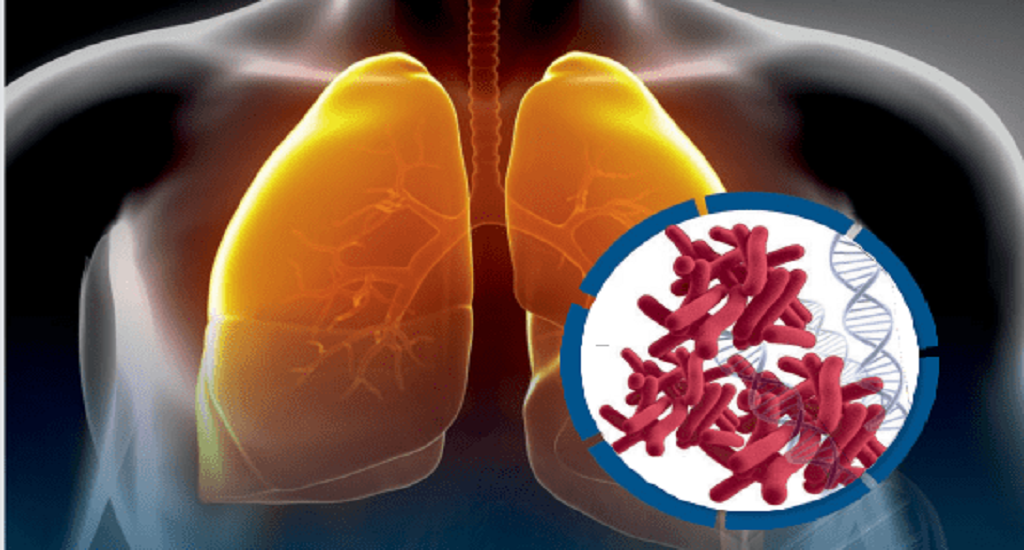 Φυματίωση: Η βιταμίνη D βελτιώνει την ανοσολογική απόκριση στη νόσο, σύμφωνα με μελέτη