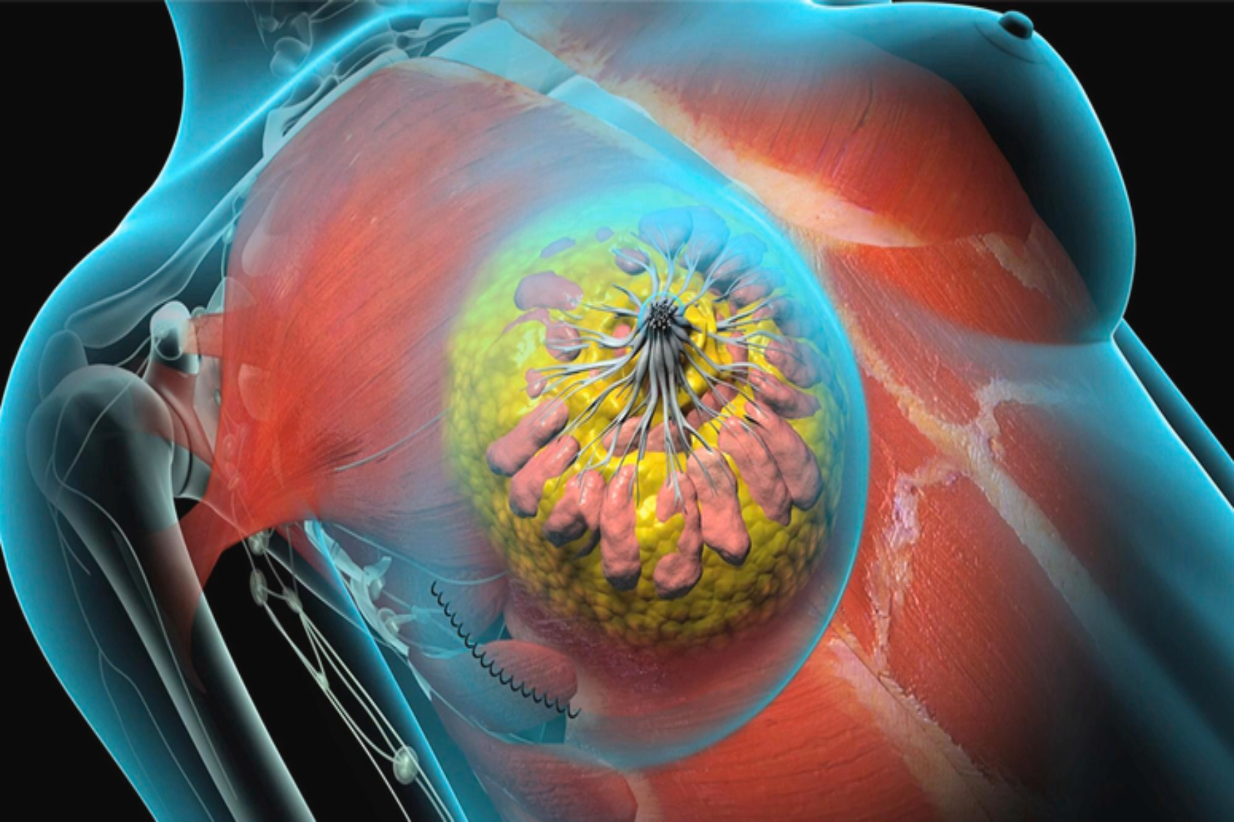 Καρκίνος: Οι ασθενείς χρειάζονται ακτινοβολία Rx μετά από χειρουργική επέμβαση καρκίνου του μαστού;