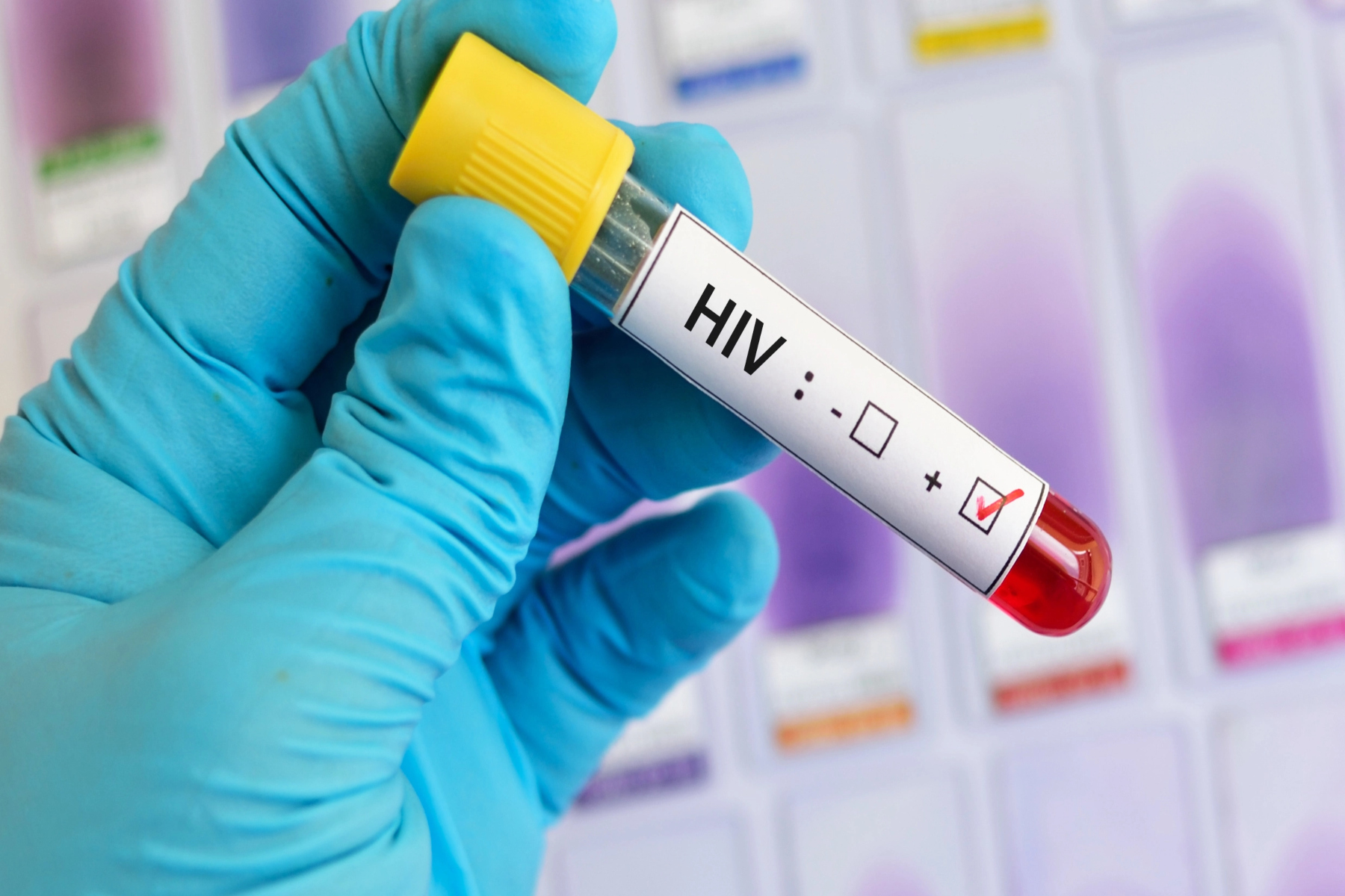 HIV: Η μεταμόσχευση βλαστοκυττάρων μπορεί να θεραπεύσει ασθενή του HIV