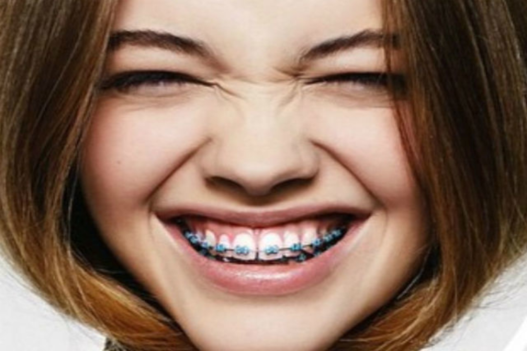 Dental beauty: Επτά συμβουλές μακιγιάζ με οδοντικά σιδεράκια