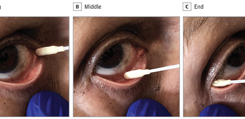 Τεστ SARS-CoV-2: Μελέτη δείχνει ότι ο ιός μπορεί να ανιχνευθεί σε δάκρυα που λαμβάνονται με οφθαλμικό επίχρισμα