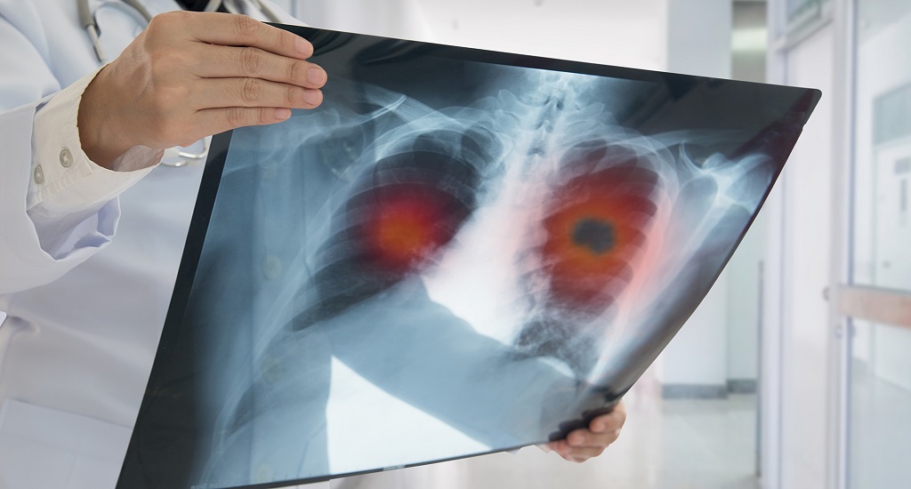 Αδενοκαρκίνωμα του Πνεύμονα: Aνακαλύφθηκε μηχανισμός στρατολόγησης των ινοβλαστών που σχετίζονται με τον καρκίνο