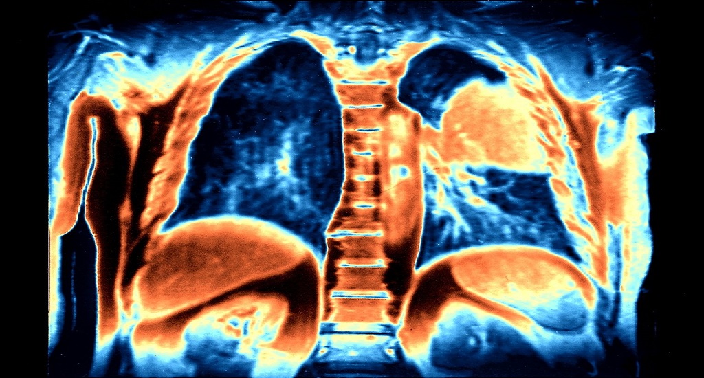 Καρκίνος του Πνεύμονα: Γιατί η νόσος δεν ανταποκρίνεται καλά στην ανοσοθεραπεία