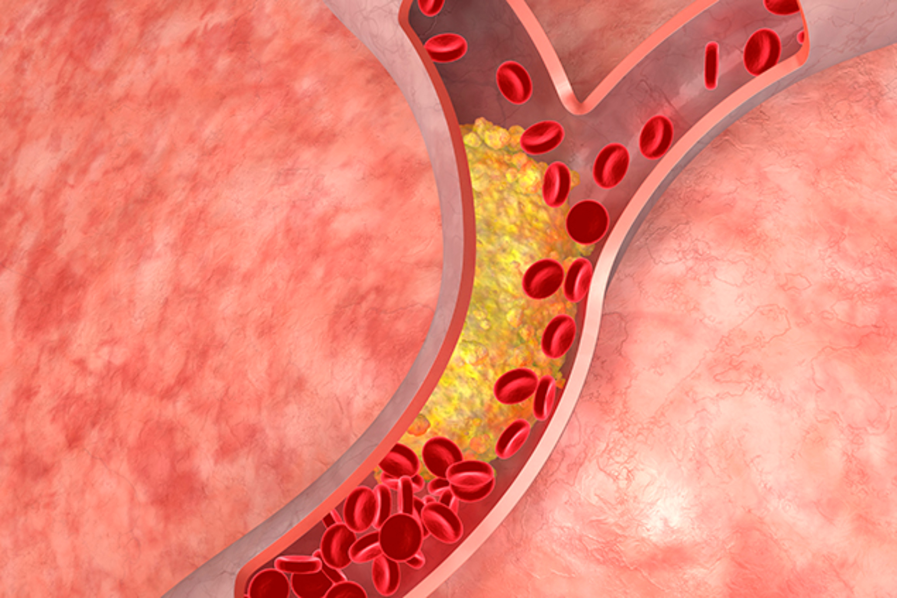 Χοληστερόλη: Ποιο είναι το υγιές επίπεδο χοληστερόλης στο αίμα;