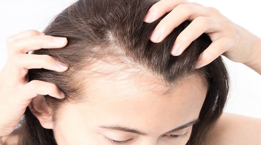 απώλεια μαλλιών γυναίκες: μερικές φορές μπορεί να υποδηλώνει μεγαλύτερα προβλήματα υγείας 7