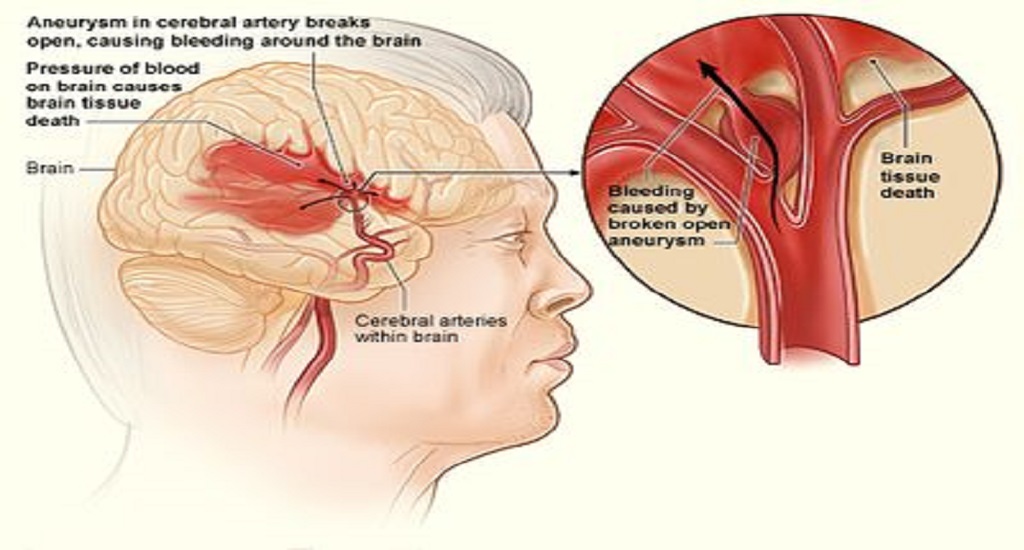 Aιμορραγικό Eγκεφαλικό: Mελέτη οδηγεί στην πρώτη θετική χειρουργική δοκιμή στον πιο θανατηφόρο τύπο επεισοδίου