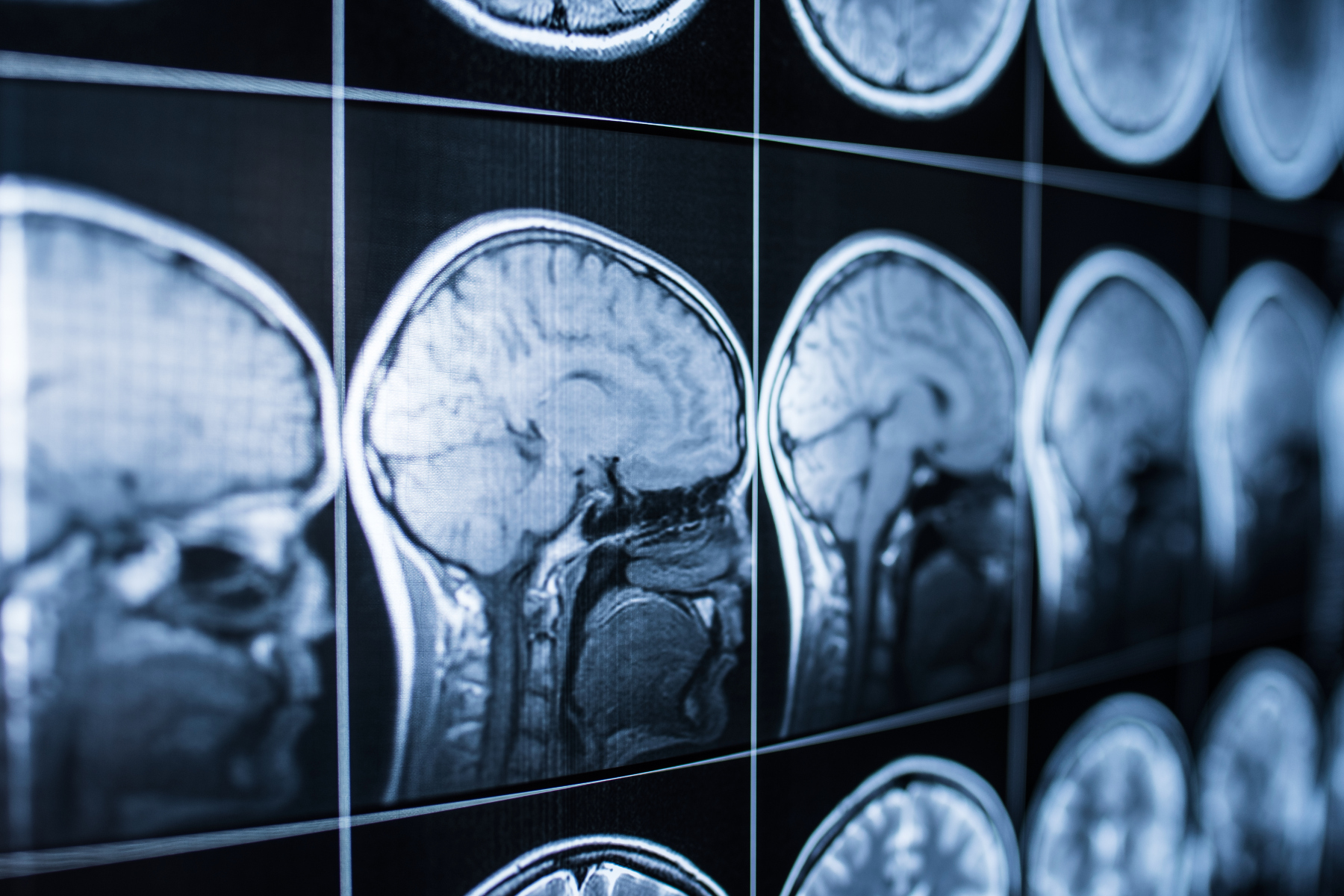 Εγκέφαλος: Πώς το σχήμα του εγκεφάλου επηρεάζει την υγεία μας;