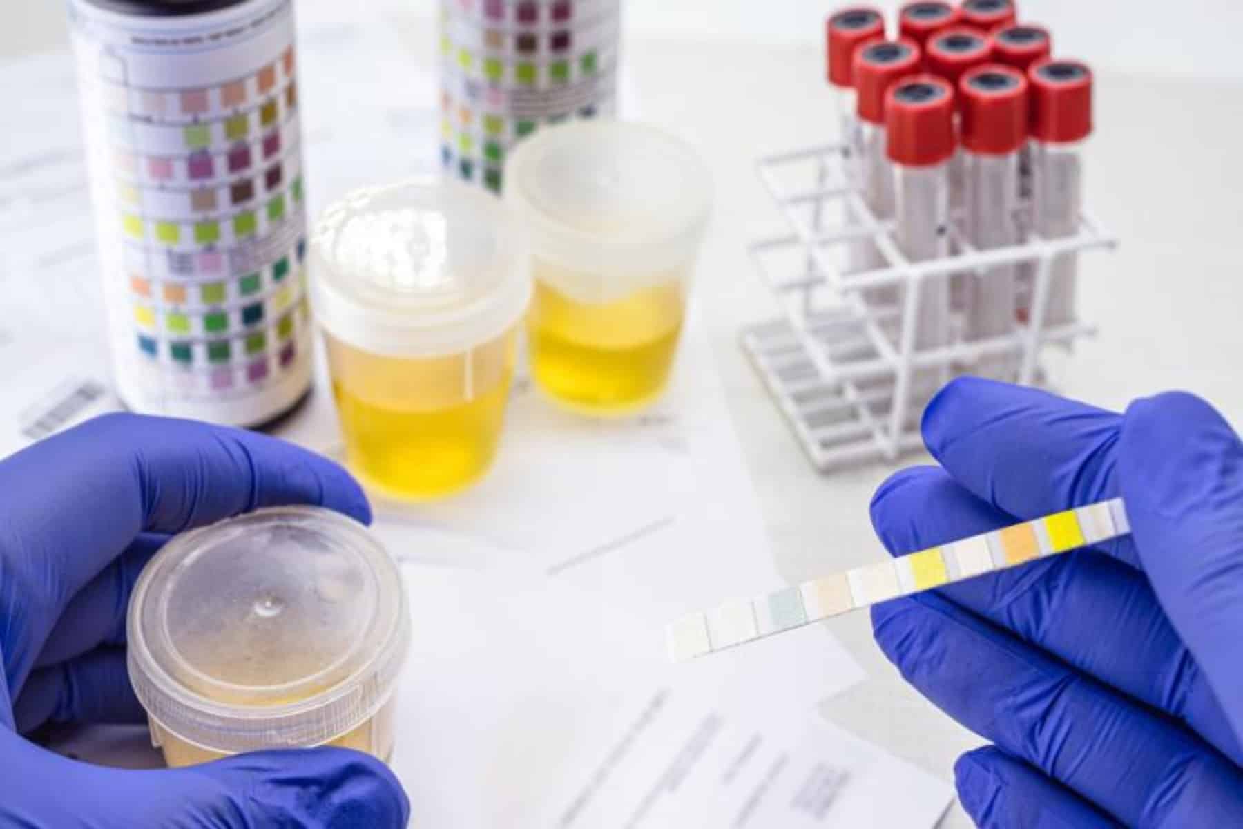 Ουρολοίμωξη: Μπορεί να τροφοδείται από E. coli στο κρέας