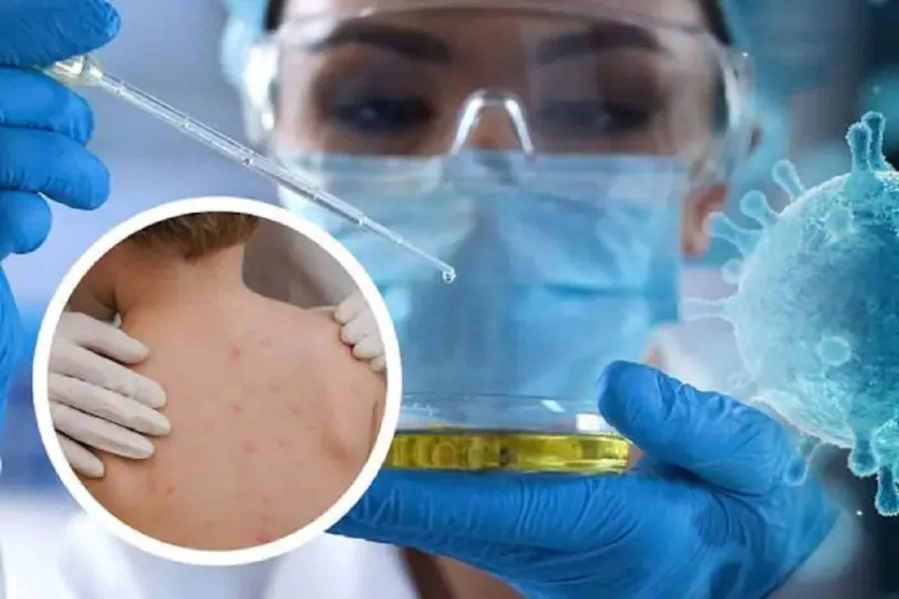 Mpox: Το Πακιστάν επιβεβαιώνει το πρώτο κρούσμα mpox στη χώρα