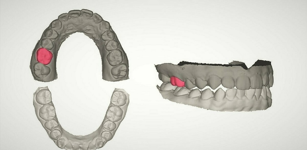 Οδοντιατρικές Στεφάνες: Ανάπτυξη τεχνολογίας για τη χρήση γενετικής τεχνητής νοημοσύνης στην κατασκευή τους