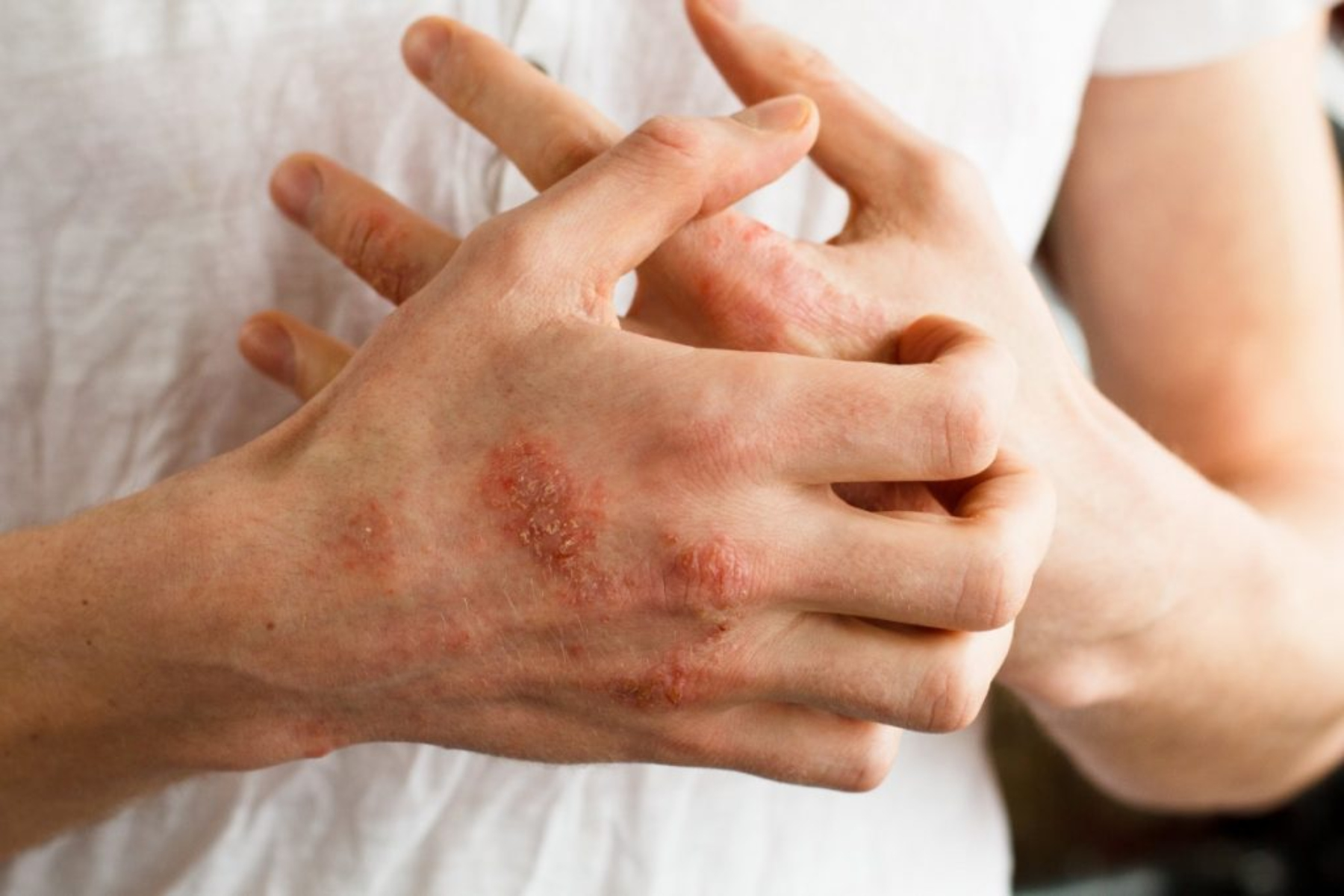 Αλλεργίες: Πώς προκαλείται η αλλεργία στο λάτεξ και πώς αντιμετωπίζεται;