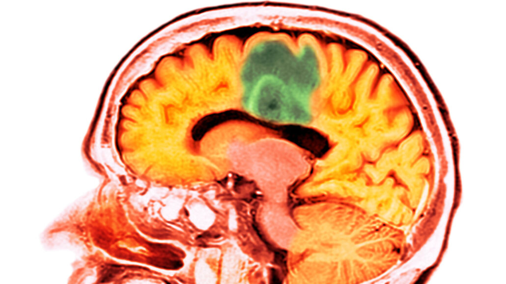 Χημειοθεραπεία Φάρμακο: Φτάνει για πρώτη φορά στον εγκέφαλο του ανθρώπου – 1η κλινική δοκιμή