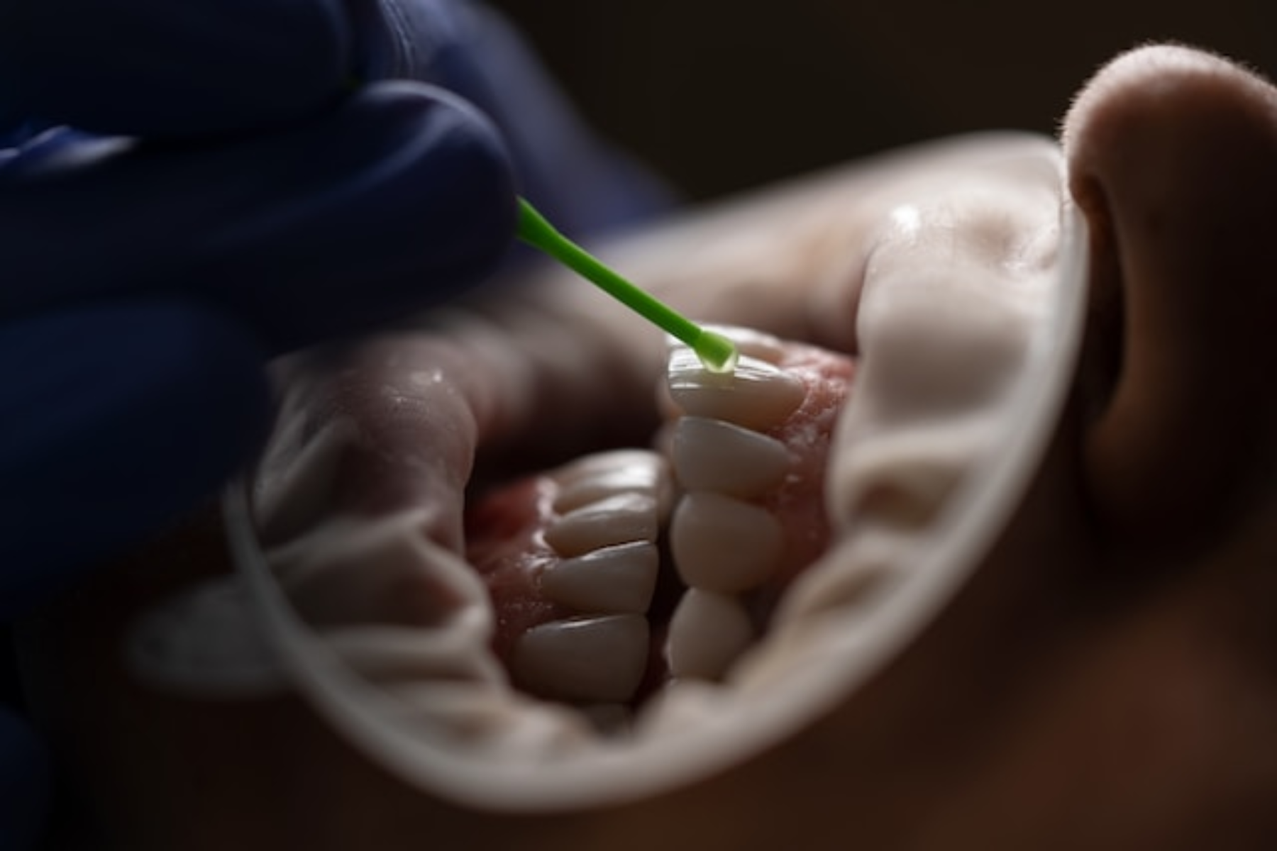 Φροντίδα δόντια: Γιατί κουνιούνται τα μόνιμα δόντια μου;