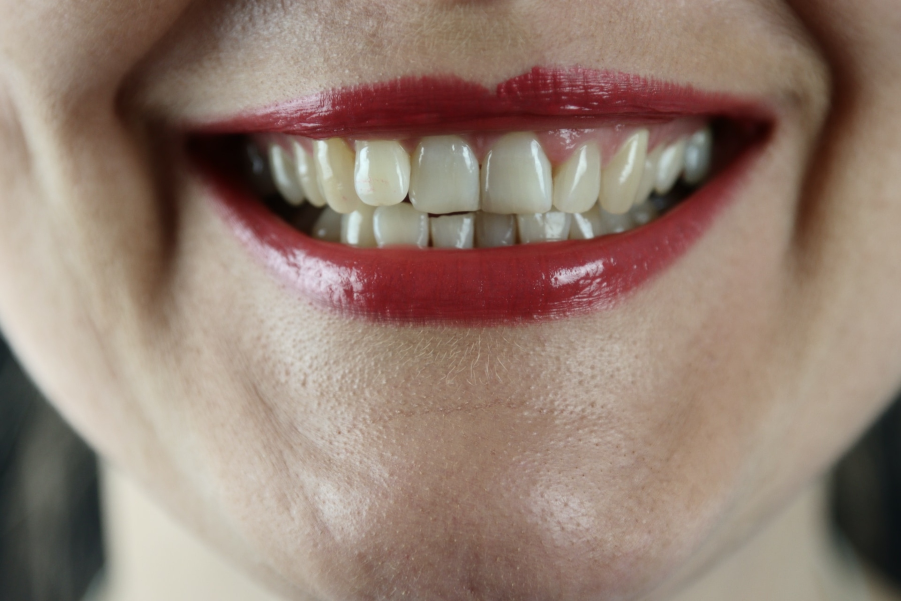 Κίτρινα δόντια: Πώς το αλάτι και το λάδι μουστάρδας μπορούν να βοηθήσουν;