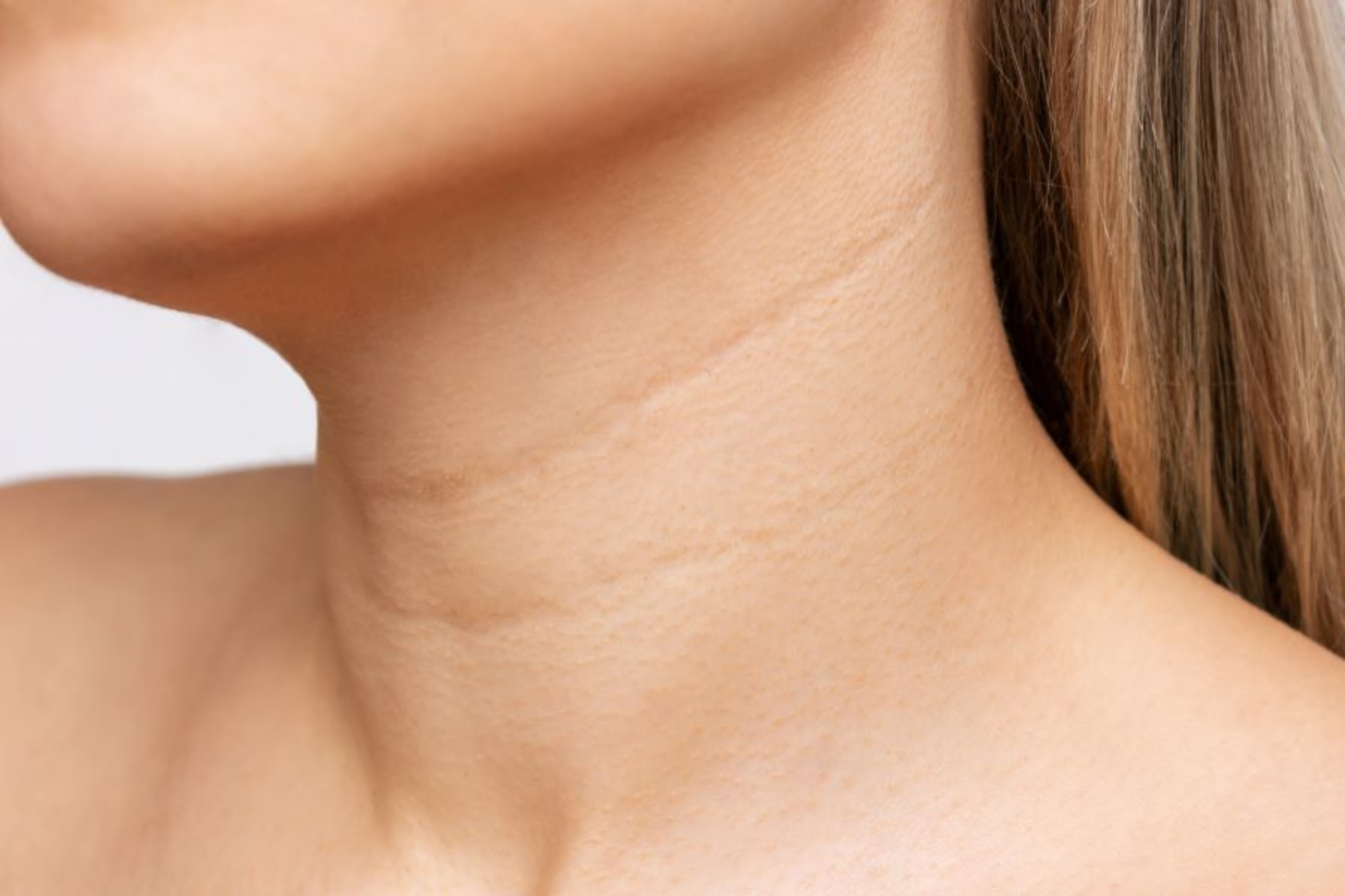 Ρυτίδες λαιμός: Συμβουλές για να απομακρύνετε τις ρυτίδες του λαιμού