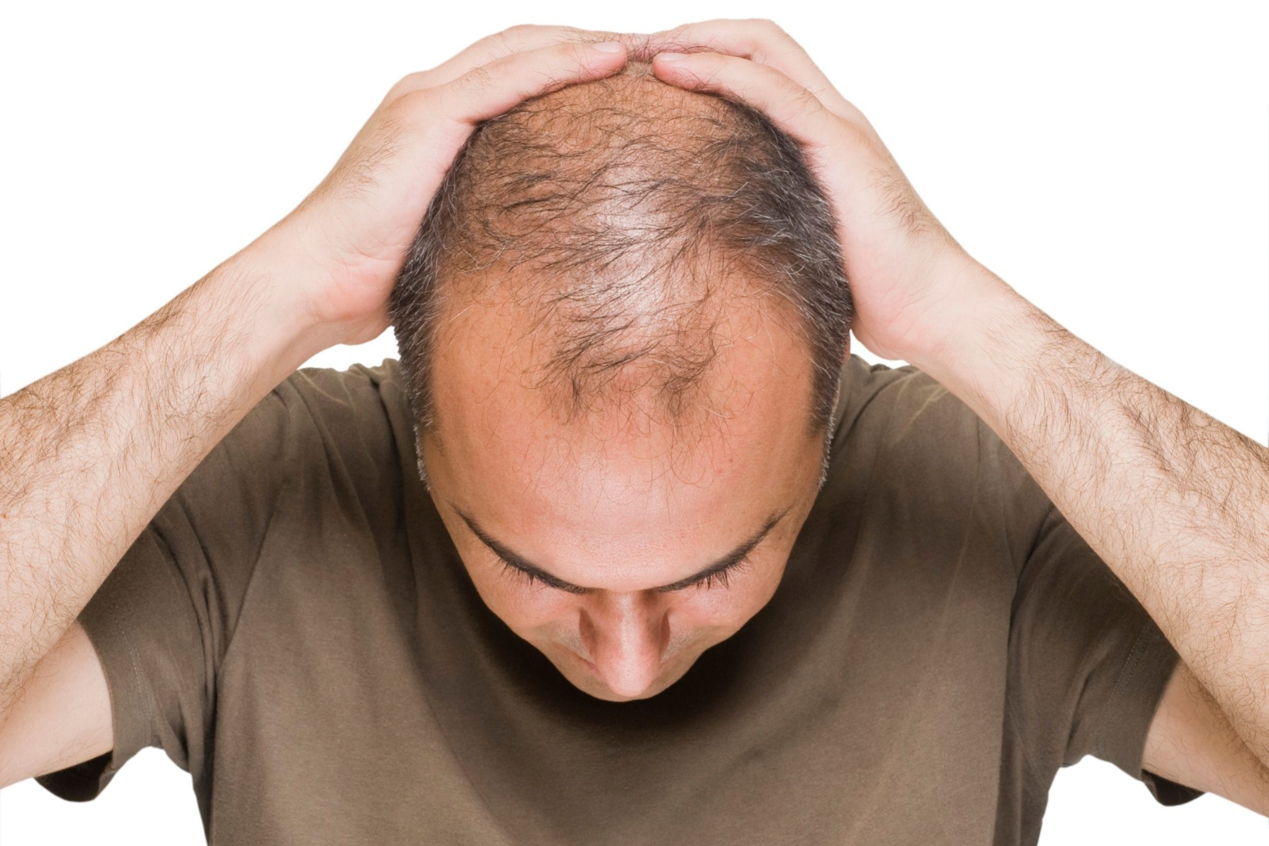 Ανδρική αραίωση μαλλιών: Πώς μπορεί να αντιμετωπιστεί η αλωπεκία;