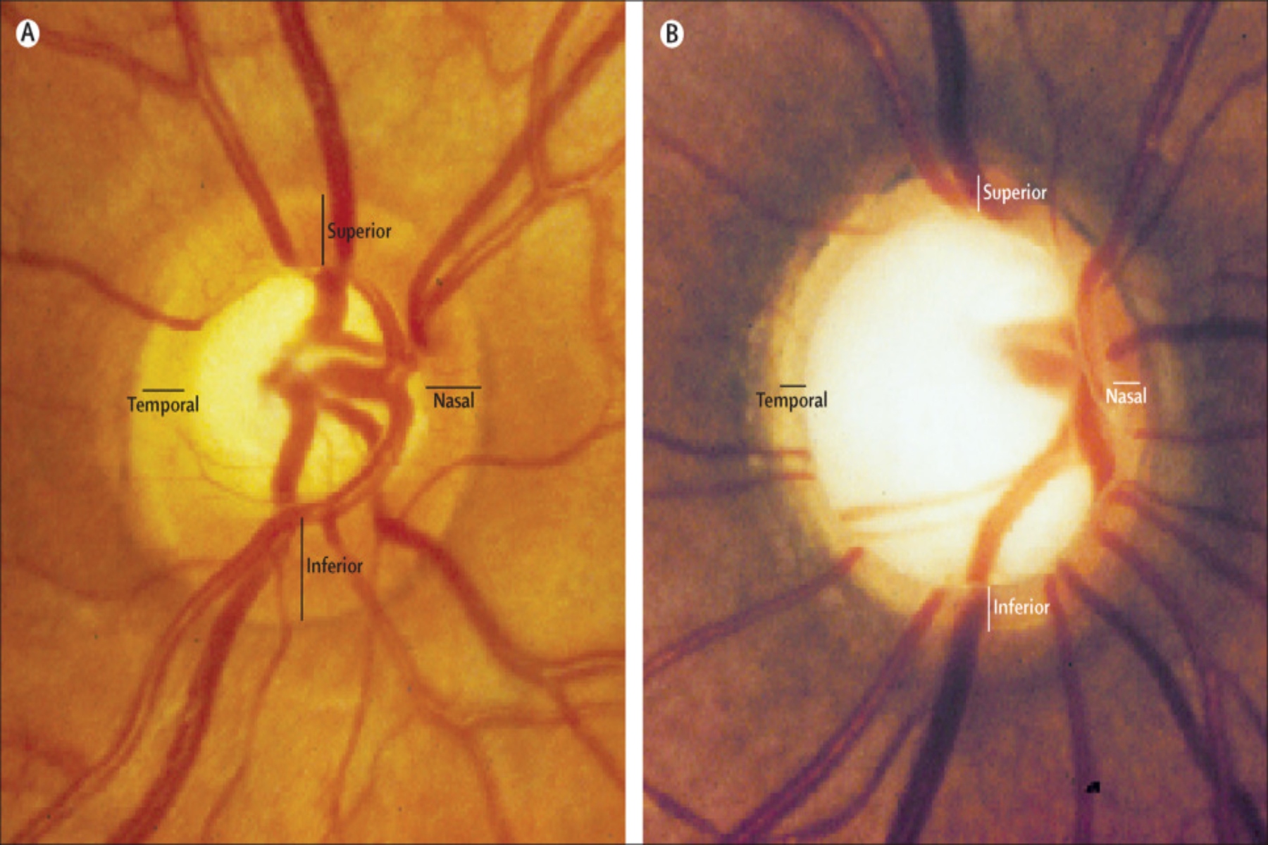 Γλαύκωμα όραση: Το γλαύκωμα μπορεί να οδηγήσει σε απώλεια όρασης! Γνωρίστε τα σημάδια για έγκαιρη διάγνωση και θεραπεία