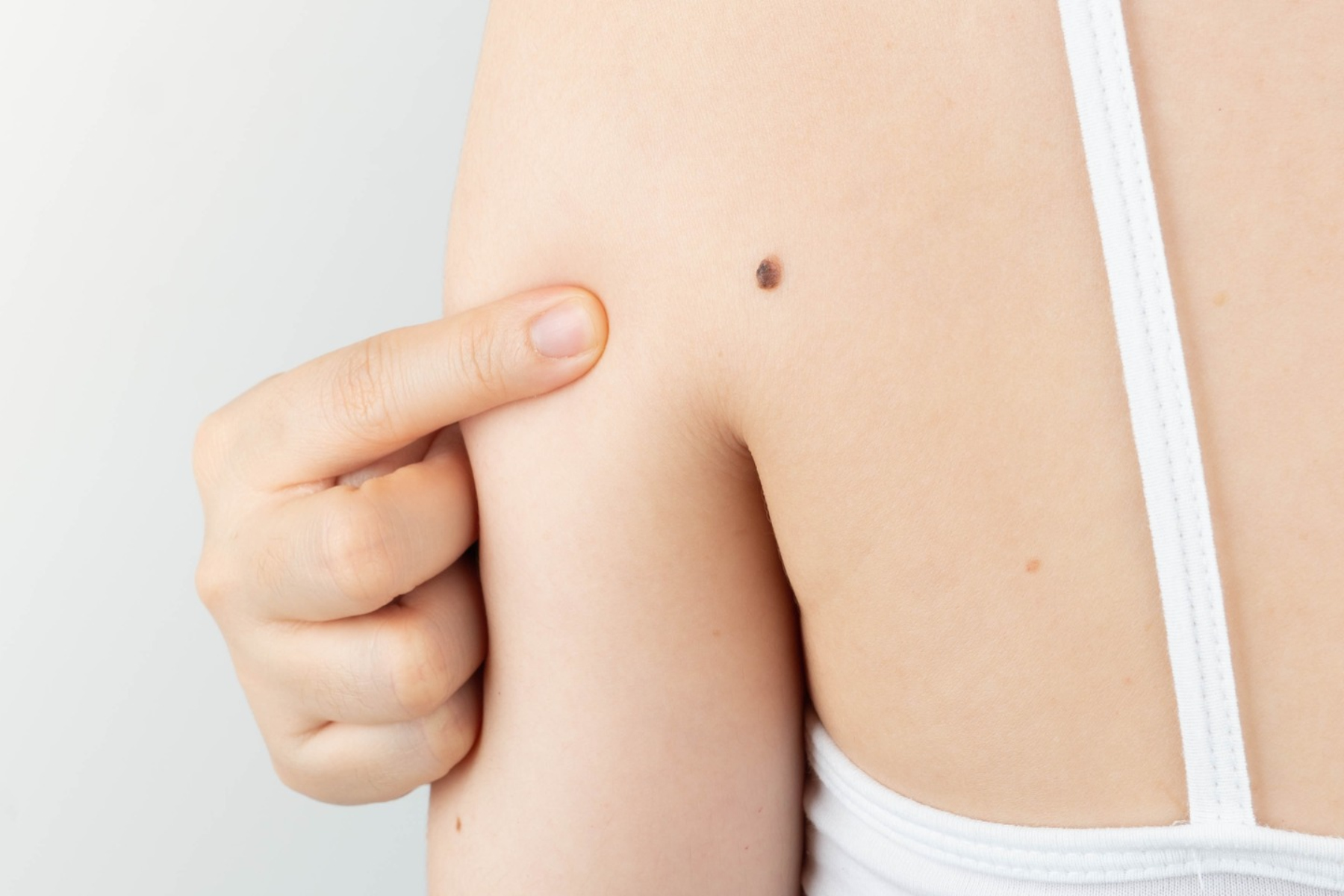 Μελάνωμα: Tips για να εξετάσετε την επιδερμίδα σας για καρκίνο του δέρματος