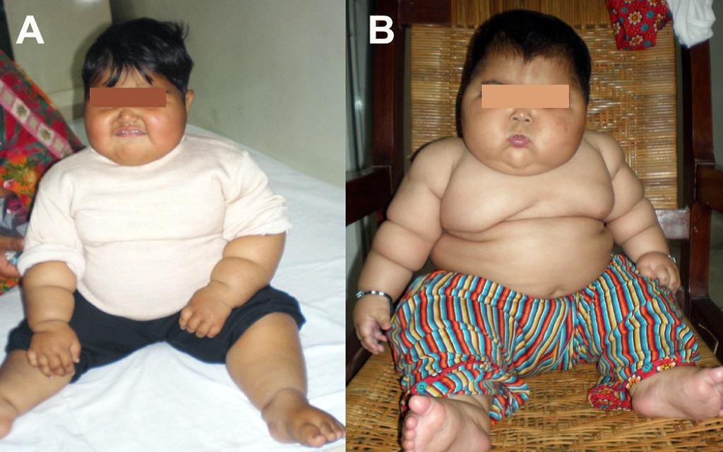 Παχυσαρκία: Σπάνιες παραλλαγές λεπτίνης που οδηγούν σε υπερφαγία βρέθηκαν σε δύο παιδιά