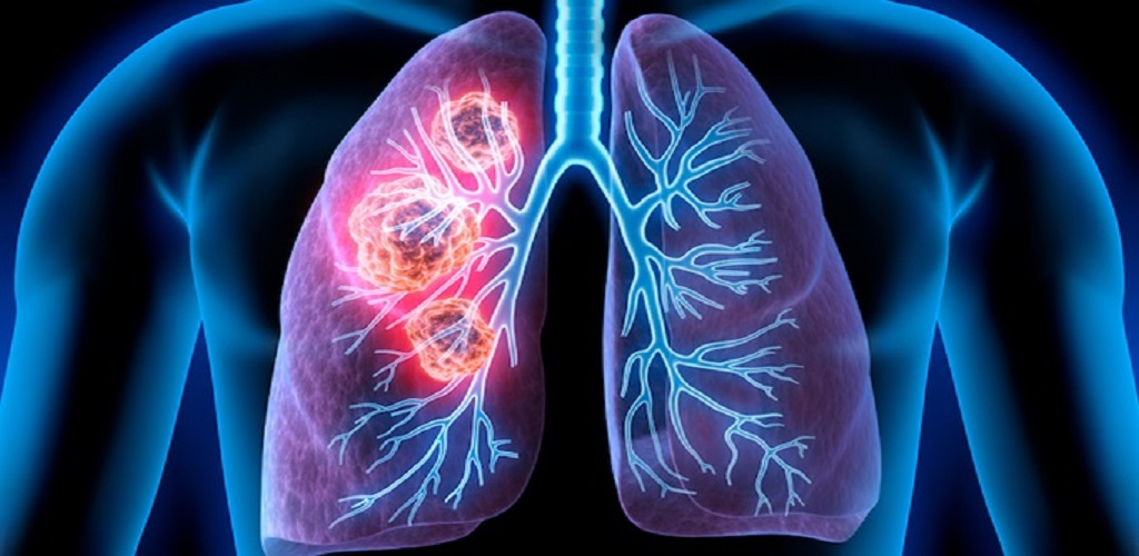 Καρκίνος του Πνεύμονα: Η διακοπή της ανοσοθεραπείας μετά από δύο χρόνια είναι λογική σε ασθενείς με προχωρημένη νόσο