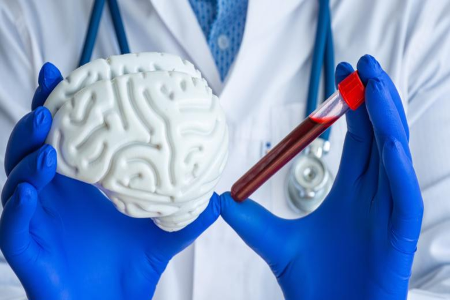 Όγκος εγκέφαλος αίμα: Επιστήμονες εντοπίζουν όγκους εγκεφάλου χρησιμοποιώντας δείγματα αίματος