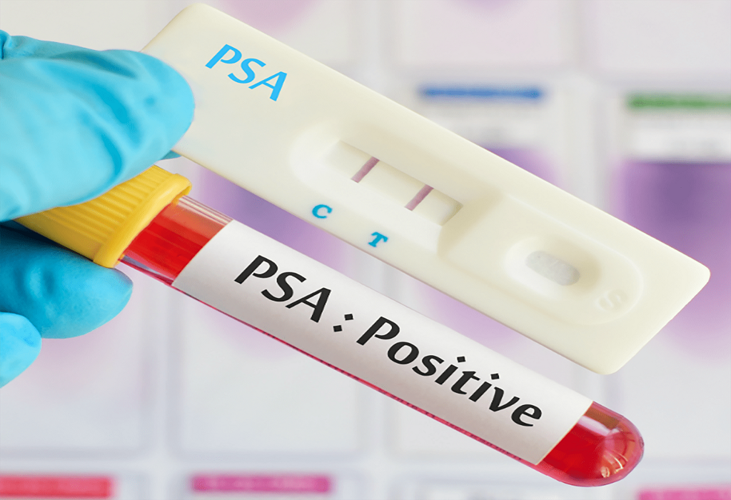 Καρκίνος του Προστάτη: Επιστήμονες πλησιάζουν σε ένα καλύτερο τεστ PSA
