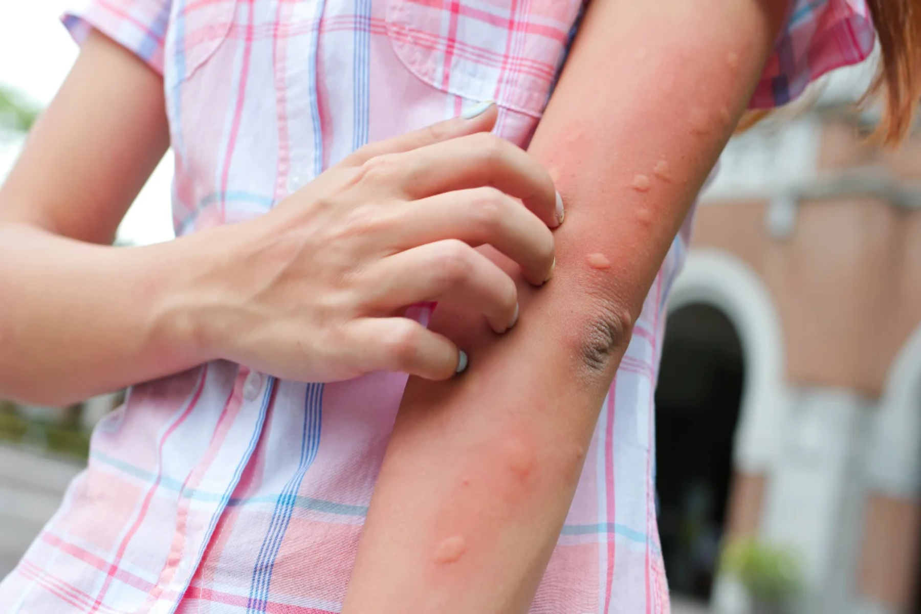 Κουνούπια: Πώς αντιμετωπίζουμε το τσίμπημα από ένα κουνούπι;
