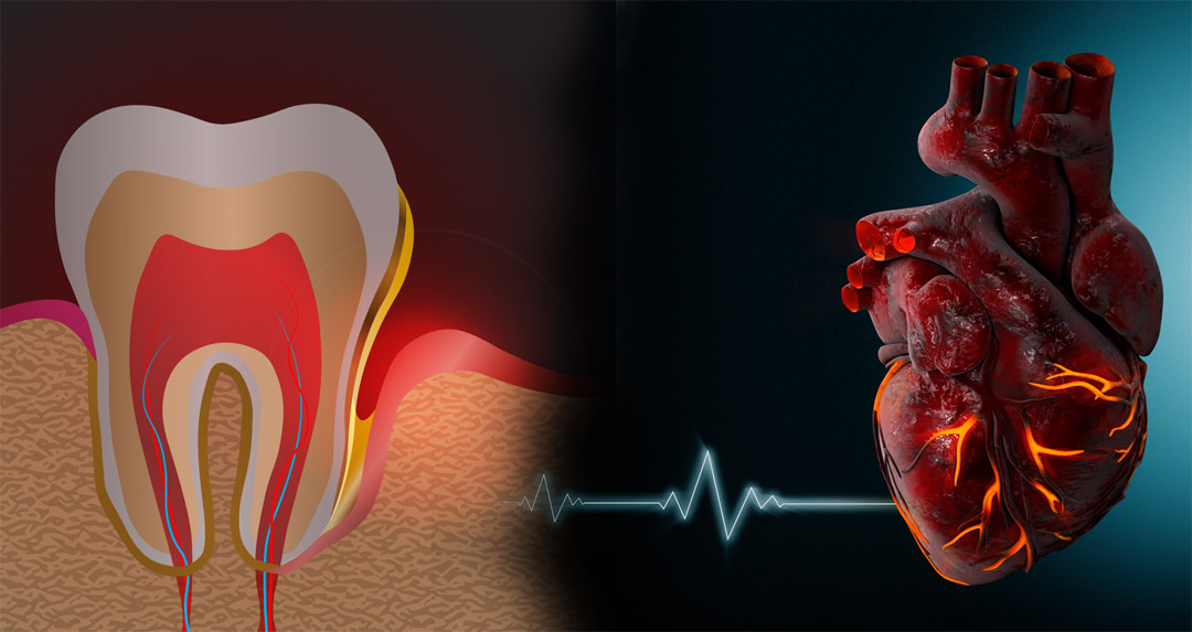 Καρδιά: Ένα απλό στοματικό ξέβγαλμα θα μπορούσε να εντοπίσει τον πρώιμο κίνδυνο καρδιακής νόσου