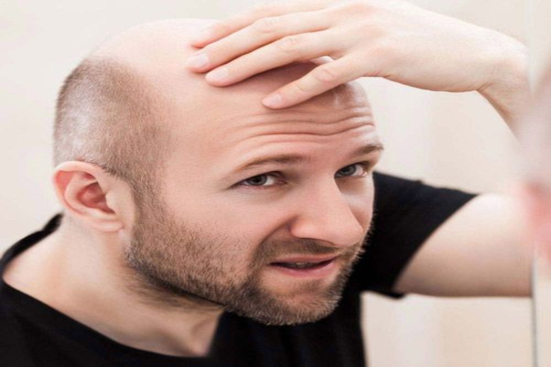 Τριχόπτωση άνδρες: Πώς η δημιουργία φαλάκρας μπορεί να επηρεάσει την ψυχική υγεία των ανδρών;