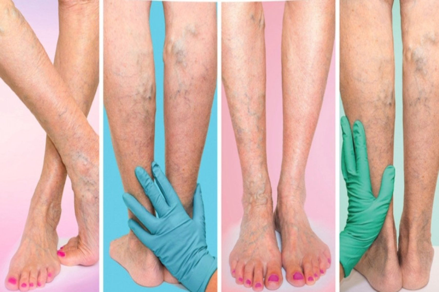 Κιρσοί πόδια: Αλλαγές στον τρόπο ζωής και θεραπείες στο σπίτι για να προλάβετε τους κιρσούς