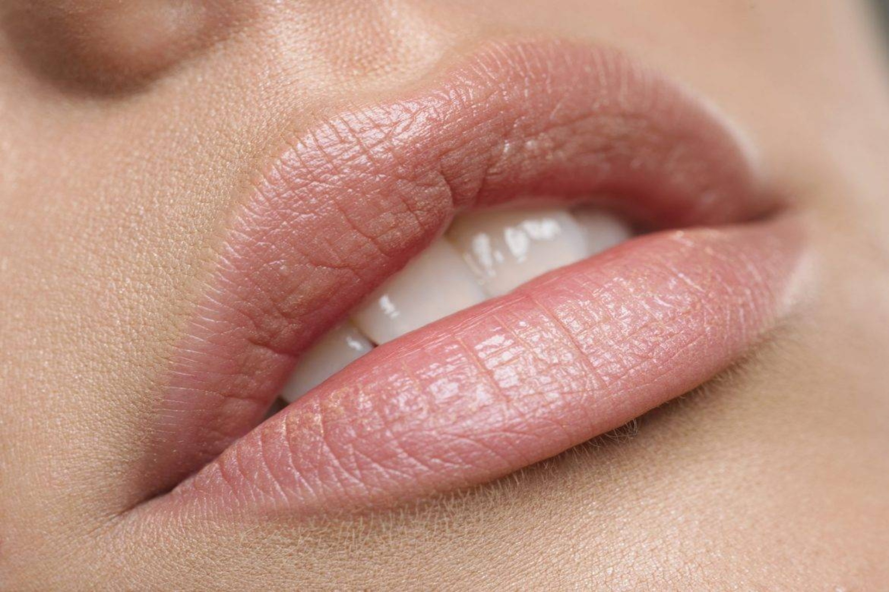 Σκασμένα χείλη: Ίσως να υποδεικνύουν έλλειψη βιταμίνης Β12
