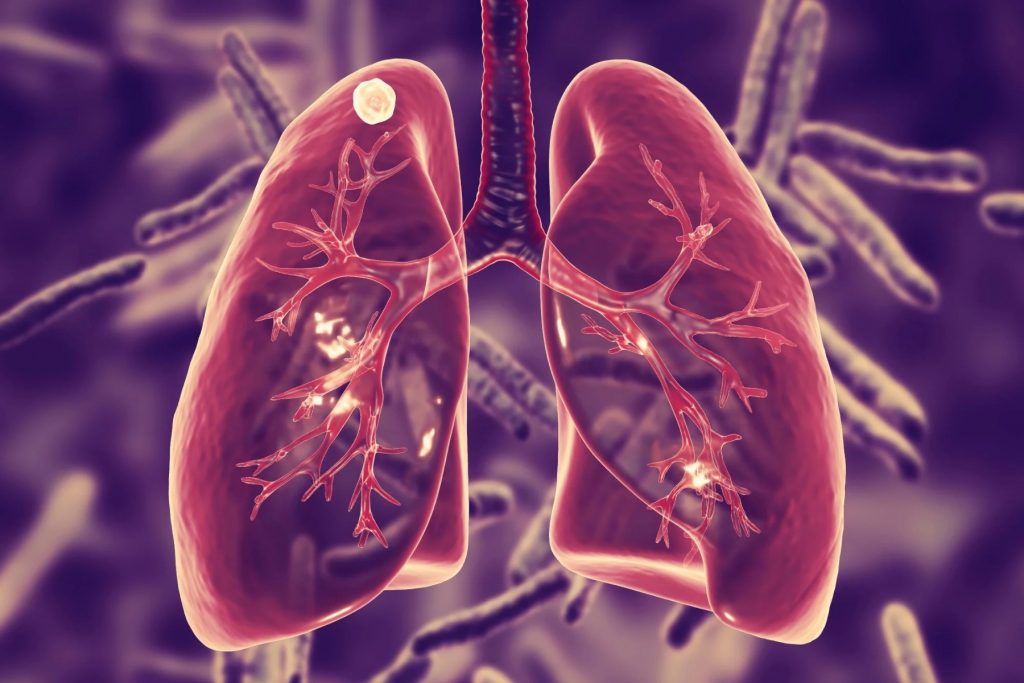 Μπορούν να χρησιμοποιηθούν δείγματα του ανώτερου αναπνευστικού για τη διάγνωση της φυματίωσης;
