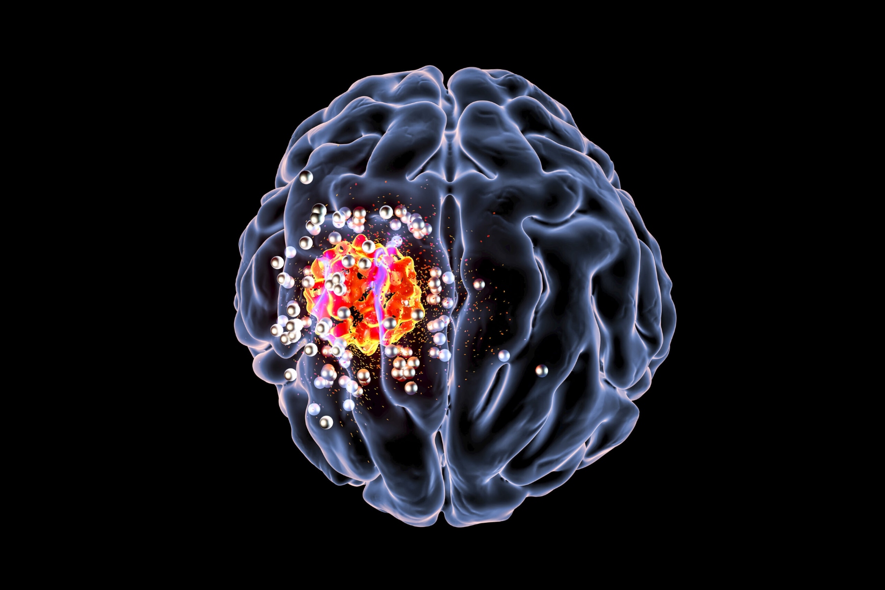 Υπέρηχος εγκέφαλος: Ο υπέρηχος επιτρέπει τη μεταφορά γονιδίων σε όλο τον εγκέφαλο