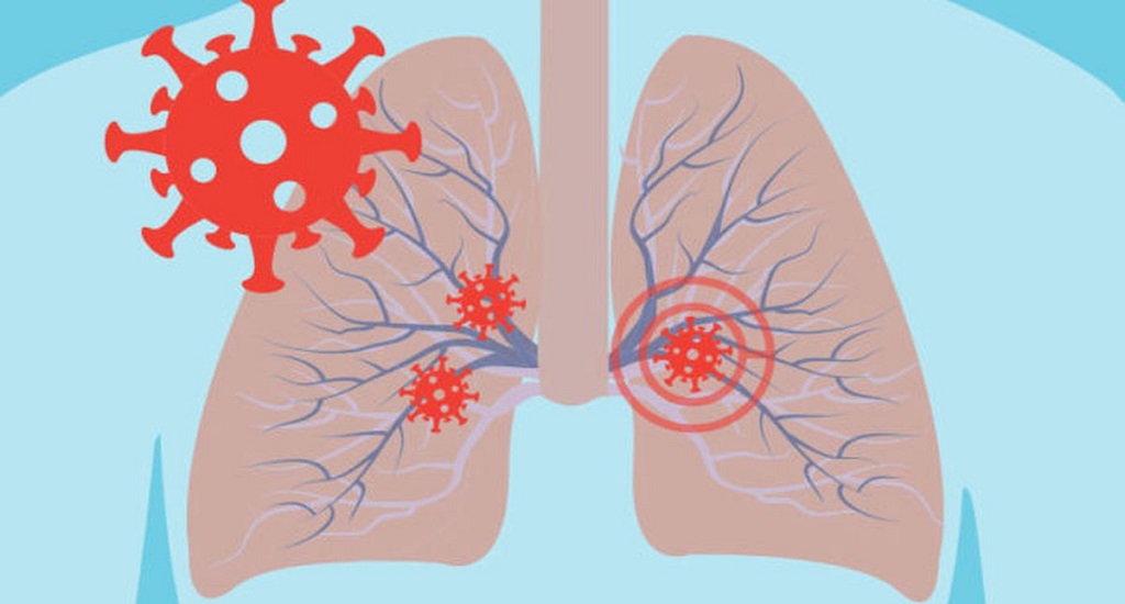 Αναπνευστική Ανεπάρκεια Πνευμονία COVID-19: Κλινική δοκιμή αποκαλύπτει τα οφέλη του εισπνεόμενου οξειδίου του αζώτου για ασθενείς