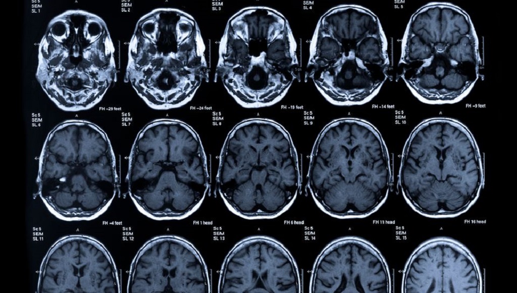 Nευρολογικές Aσθένειες: Μη επεμβατική τεχνολογία χαρτογραφεί την εγκεφαλική δραστηριότητα για να διερευνήσει τις αλλαγές συμπεριφοράς