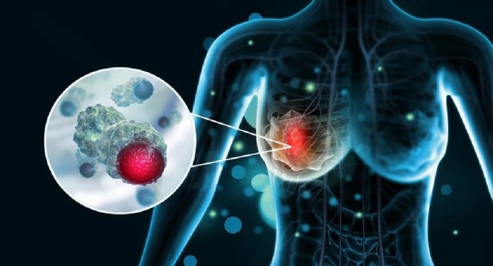 Καρκίνος του Μαστού: Ερευνητές μελετούν πώς να αποτρέψουν την υποτροπή της νόσου