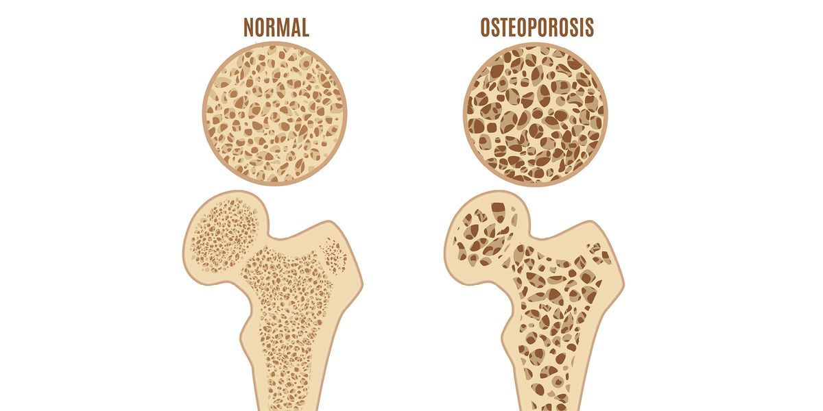 Ιδιοπαθής Οστεοπόρωση: Γενετική μετάλλαξη μπορεί να βρίσκεται πίσω από ορισμένες περιπτώσεις της σοβαρής νόσου