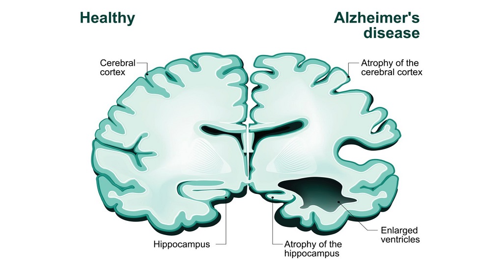 Αλτσχάιμερ: Κατανόηση του ρόλου της διατροφής στην τροποποίηση του κινδύνου εμφάνισης της νόσου