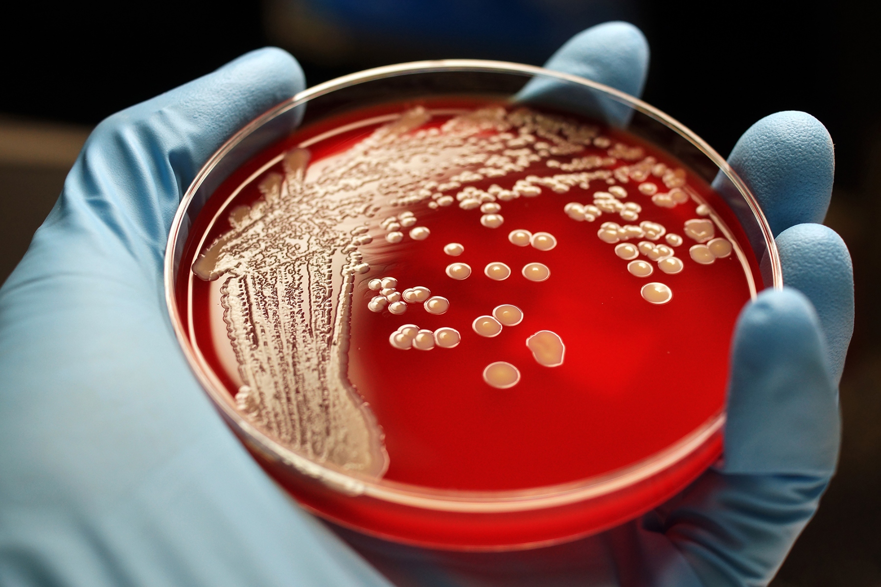 CDC: Αυξάνονται τα κρούσματα φυματίωσης στις ΗΠΑ