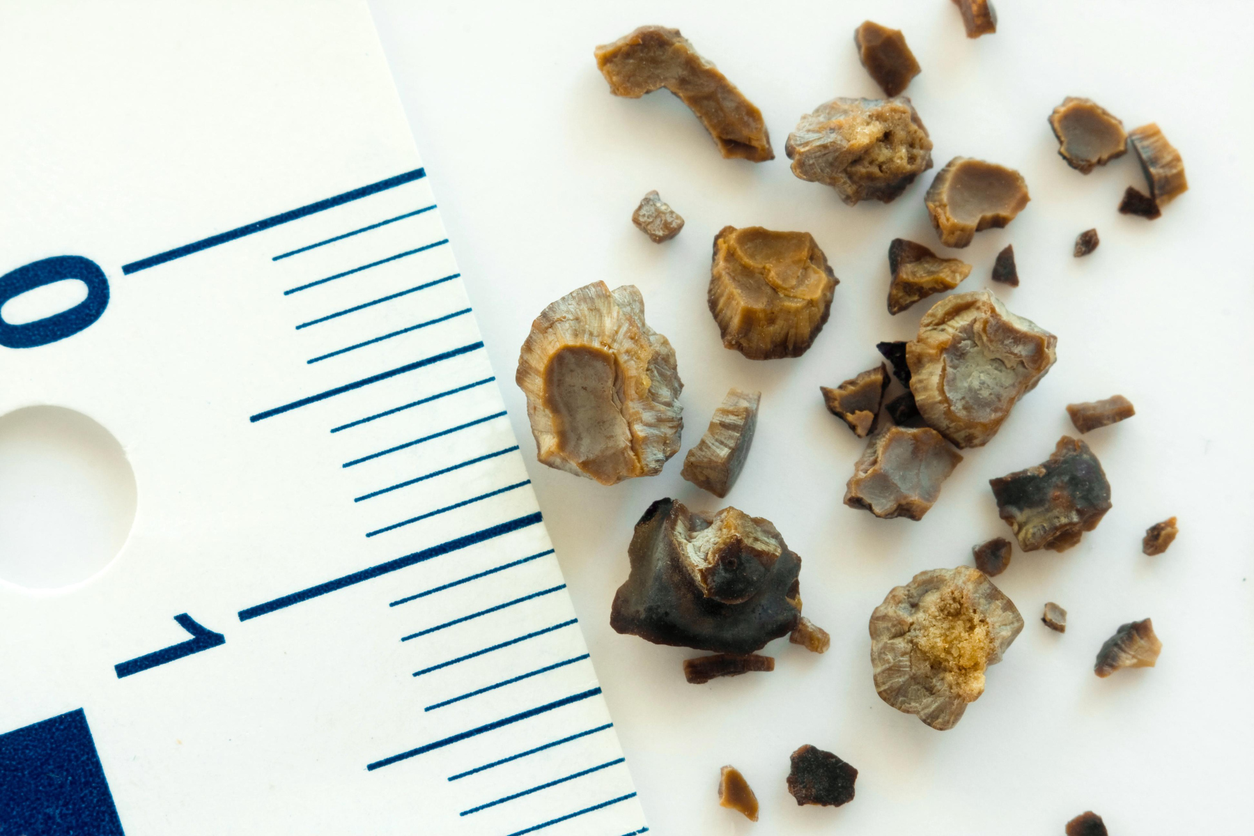 Πέτρα στα νεφρά: Πώς αντιμετωπίζονται οι πέτρες στα νεφρά;