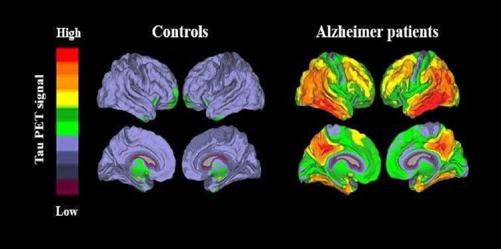 Αλτσχάιμερ: Οι διαφορές στο εγκεφαλονωτιαίο υγρό ασθενών με τη νόσο υποδηλώνουν πιθανότητα παραλλαγών