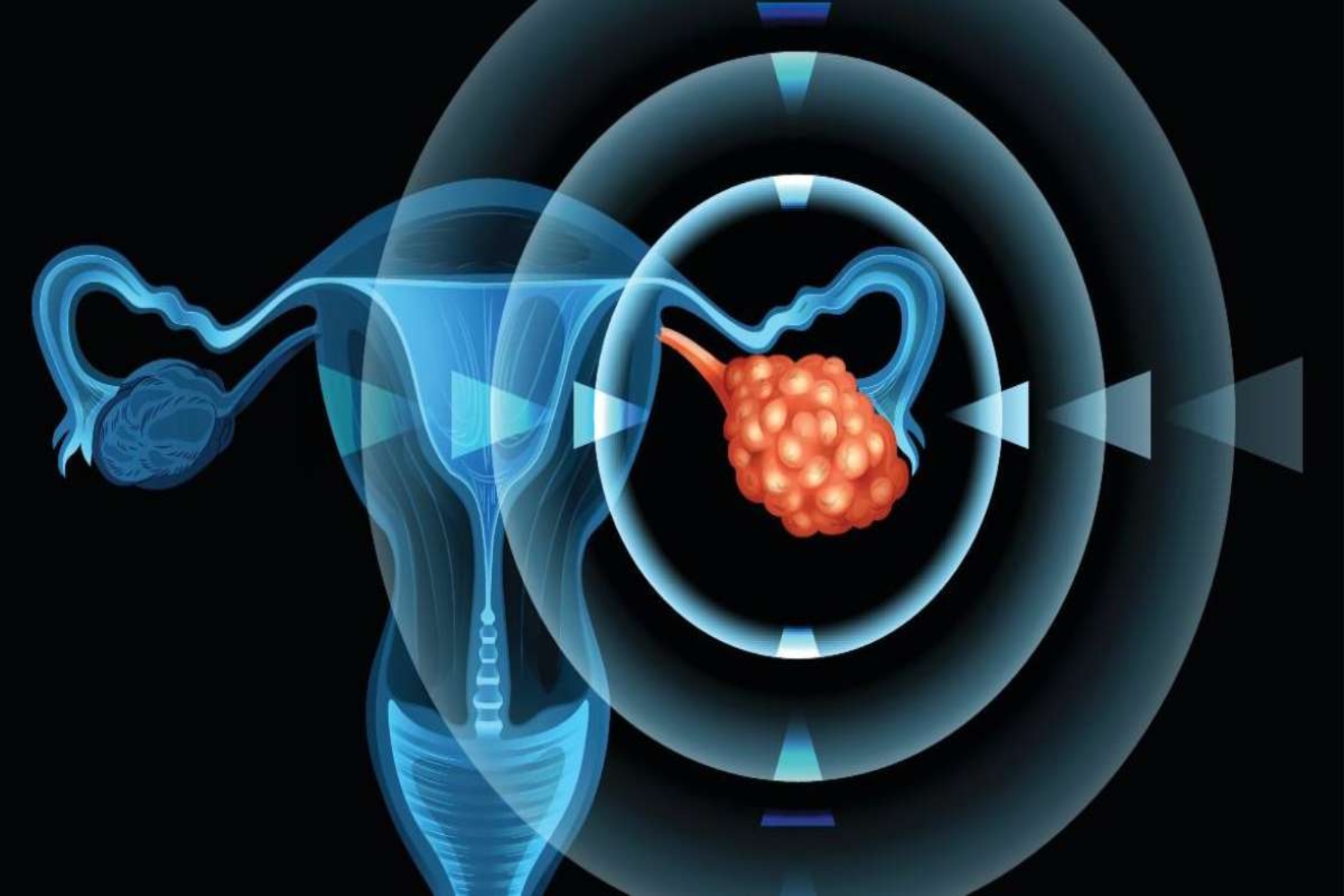 Καρκίνος ωοθηκών: Συμπτώματα και διάγνωση του καρκίνου των ωοθηκών