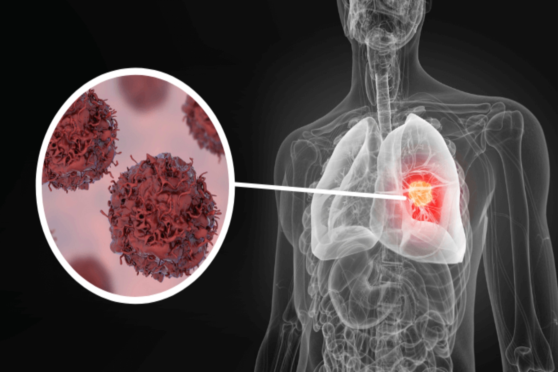 Καρκίνος πνεύμονας: Ποια είναι η πιο συχνή θεραπεία που χρησιμοποιείται για τον καρκίνο του πνεύμονα;