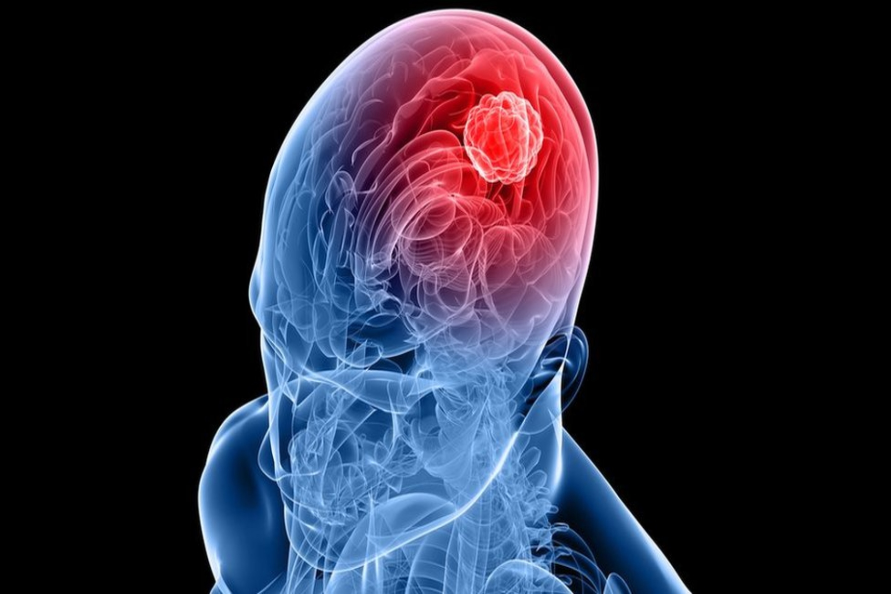 Γλοιοβλάστωμα: Τα σημάδια της επιθετικής μορφής καρκίνου του εγκεφάλου
