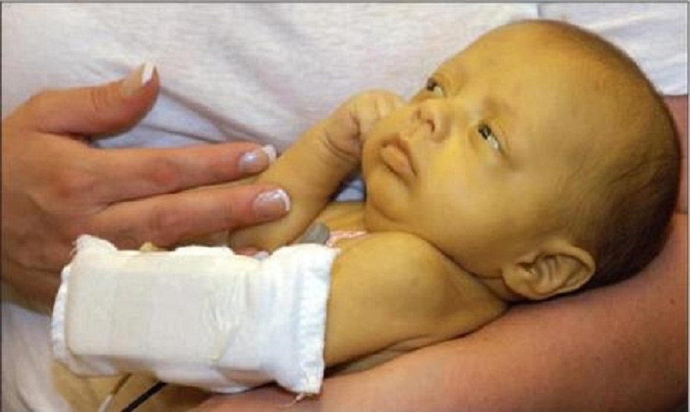Δρεπανοκυτταρική Αναιμία: Τα περισσότερα μωρά με την ασθένεια αντιμετωπίζουν διπλά μειονεκτήματα, λένε ερευνητές