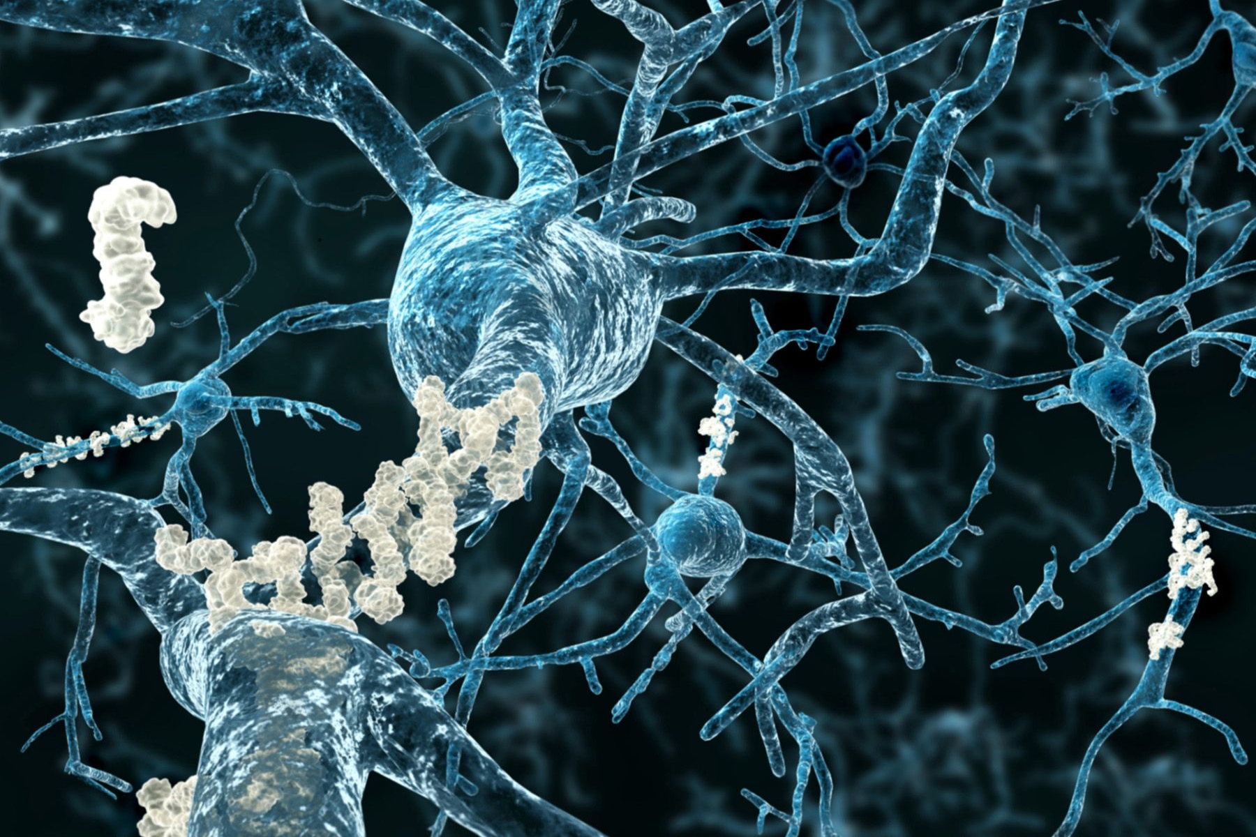 Νόσος Πάρκινσον: Νευροεκφυλιστικές ασθένειες που συνδέουν πρωτεΐνες και νευρωνική επικοινωνία