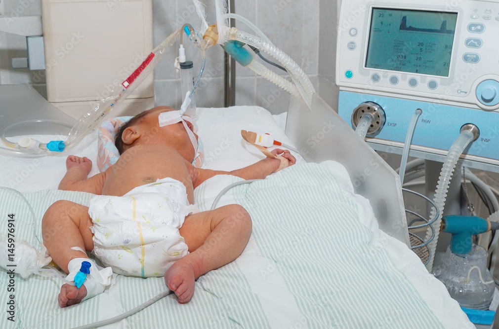 Aναπνευστήρες: Γιατί μπορεί να είναι σκληροί στους πνεύμονες των πρόωρων μωρών