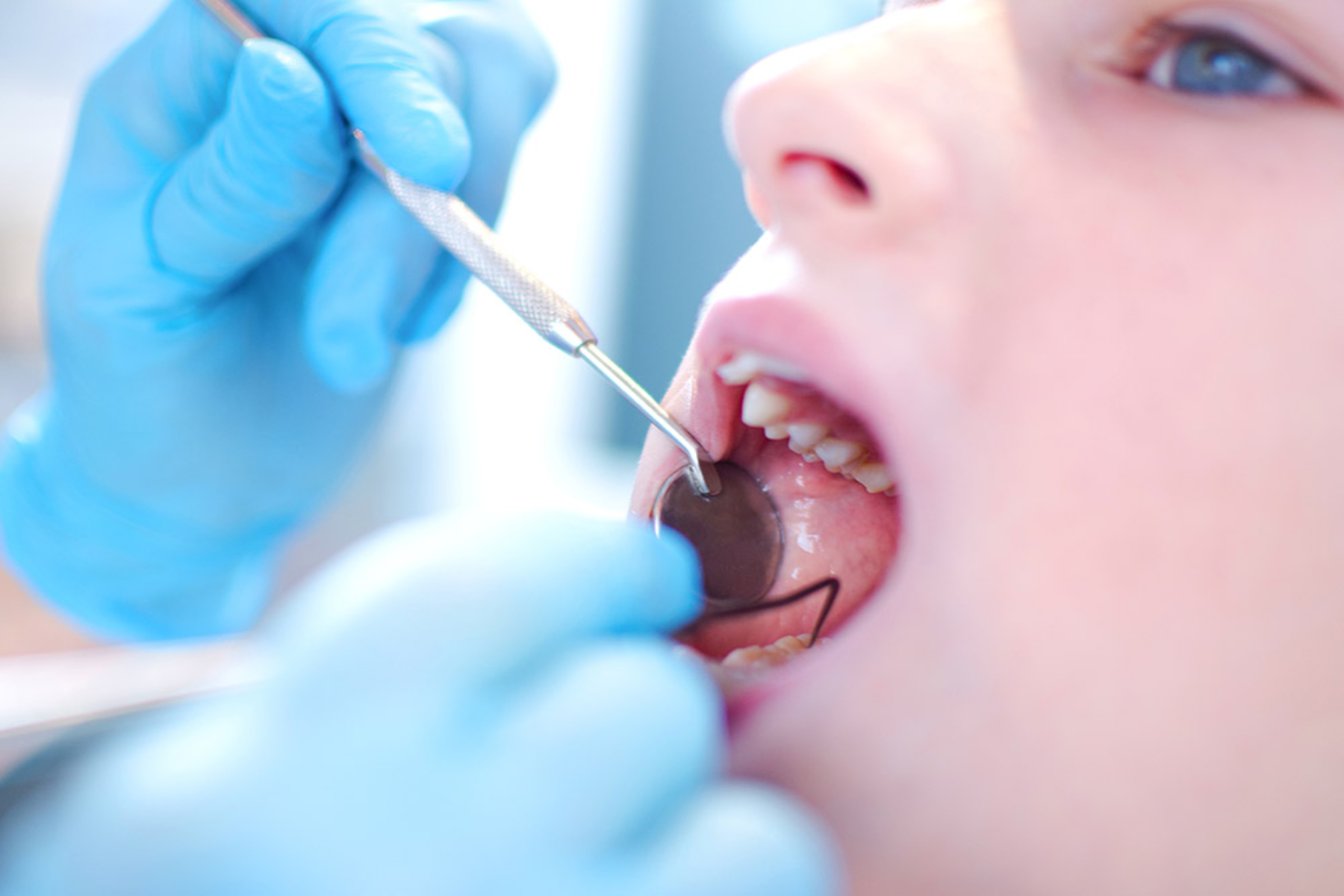 Δόντια προστασία: Προσέξτε αυτά τα πρώιμα σημάδια τερηδόνας στα παιδιά για να προστατέψετε τα δόντια τους